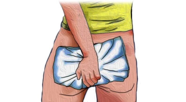 Symptômes désagréables des hémorroïdes traitées avec la crème Proctonic